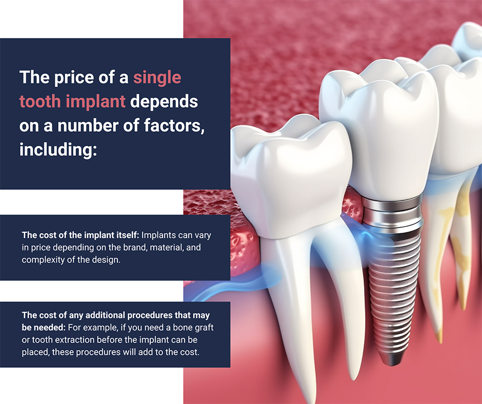 How Much is a Single Tooth Implant?