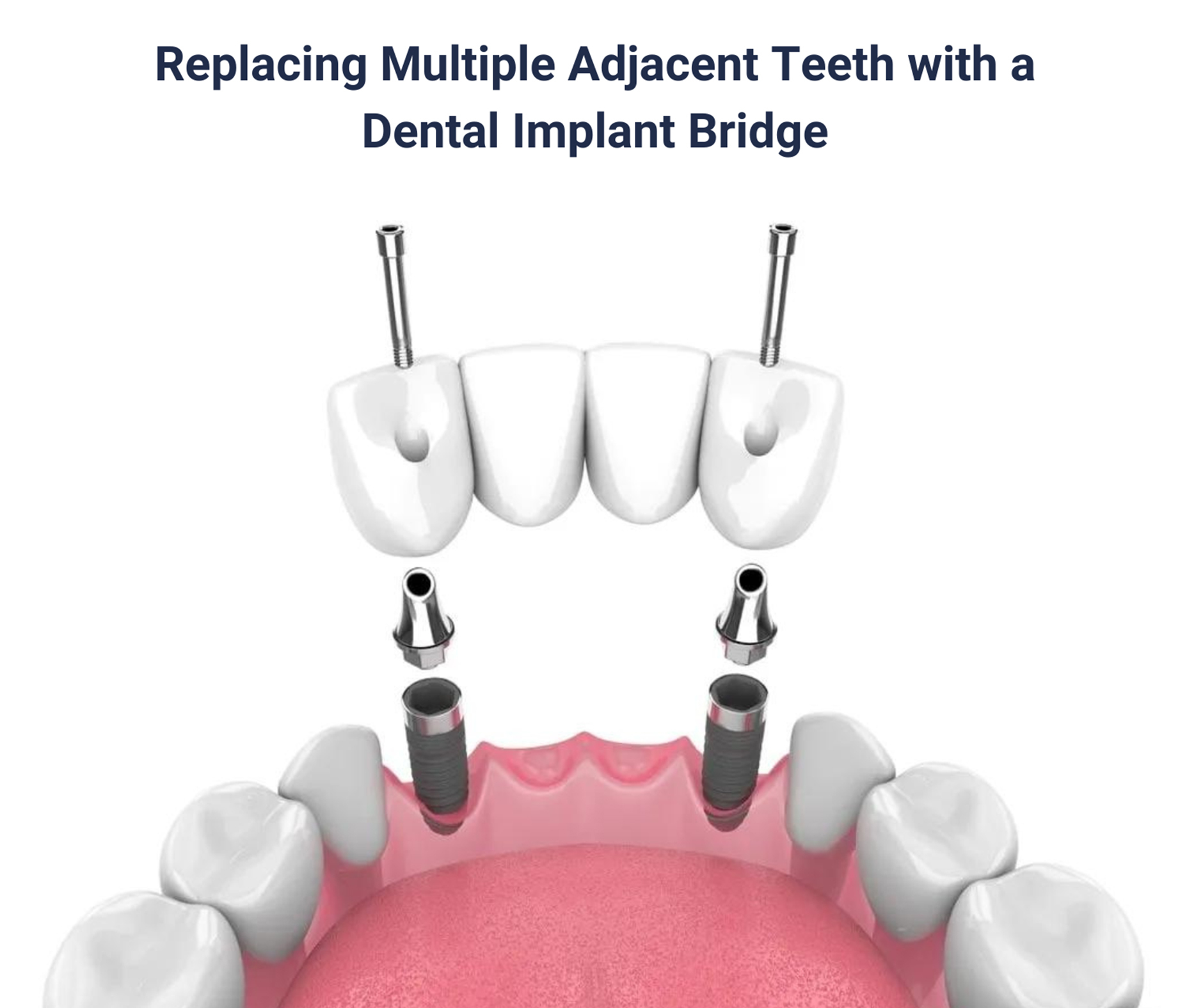 Replacing Multiple Adjacent Teeth with a Dental Implant Bridge