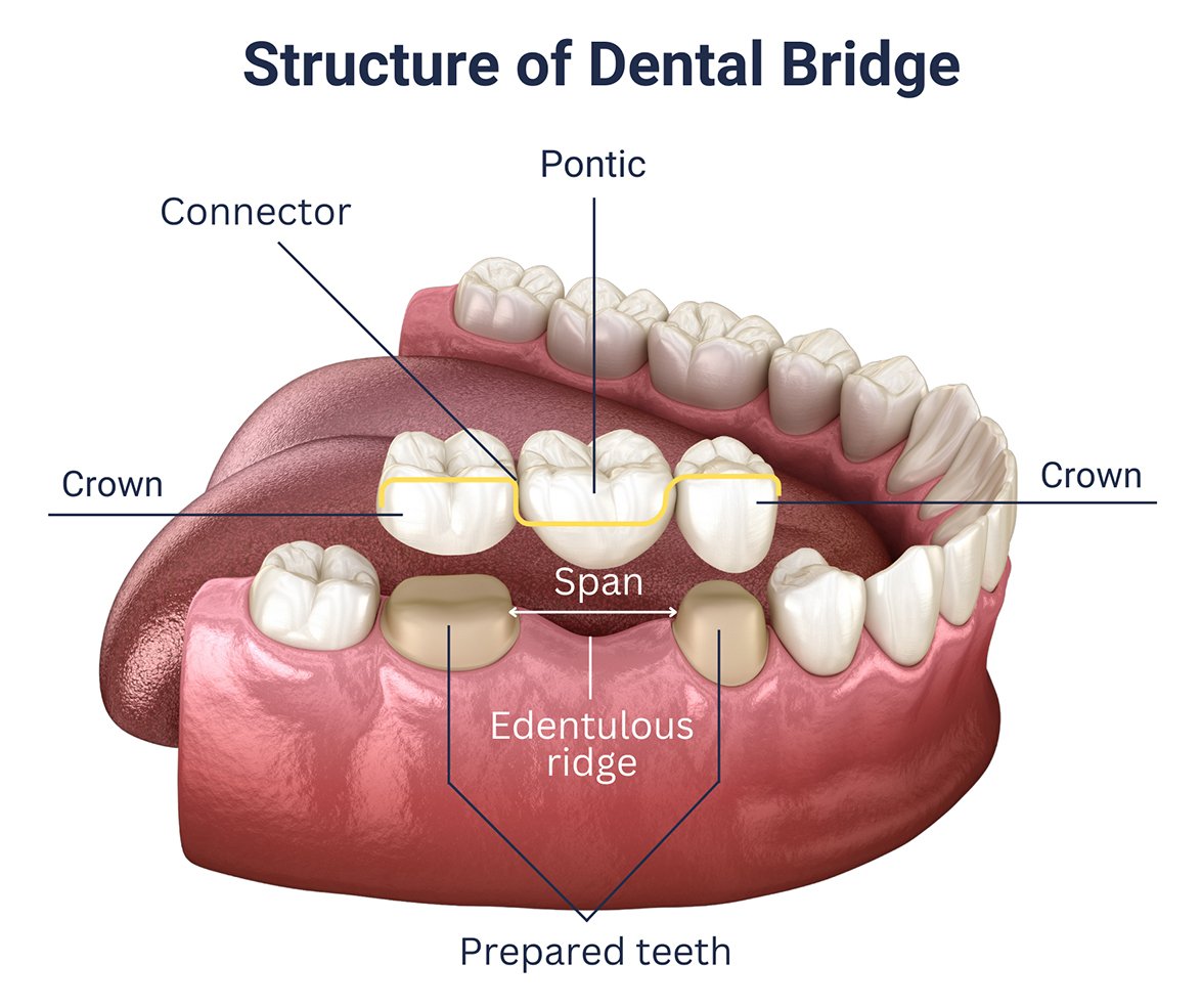 Structure of Dental Bridge