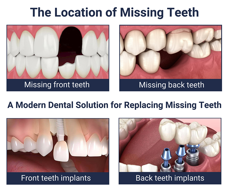 The Location of Your Missing Teeth