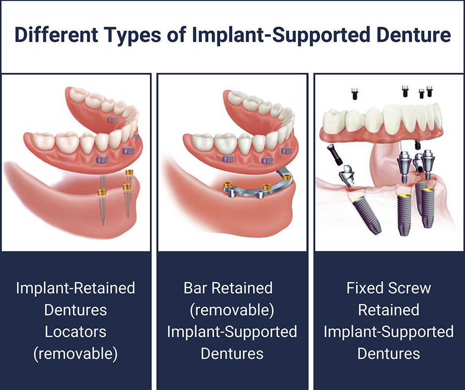 Different Types of Implant-Supported Denture