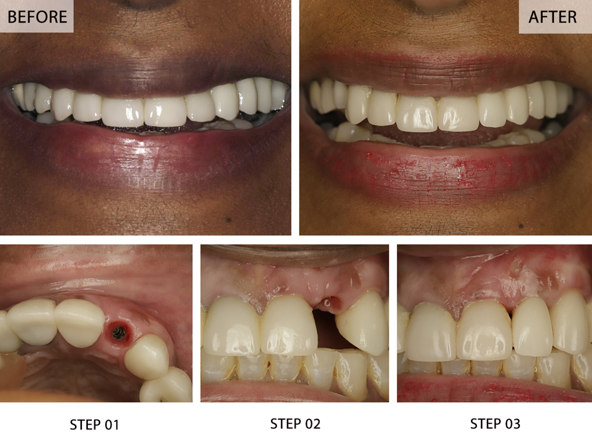 https://www.nycdentalimplantscenter.com/wp-content/uploads/2024/08/front-tooth-dental-implants-before-after-images-12.jpg?utm_source=chatgpt.com