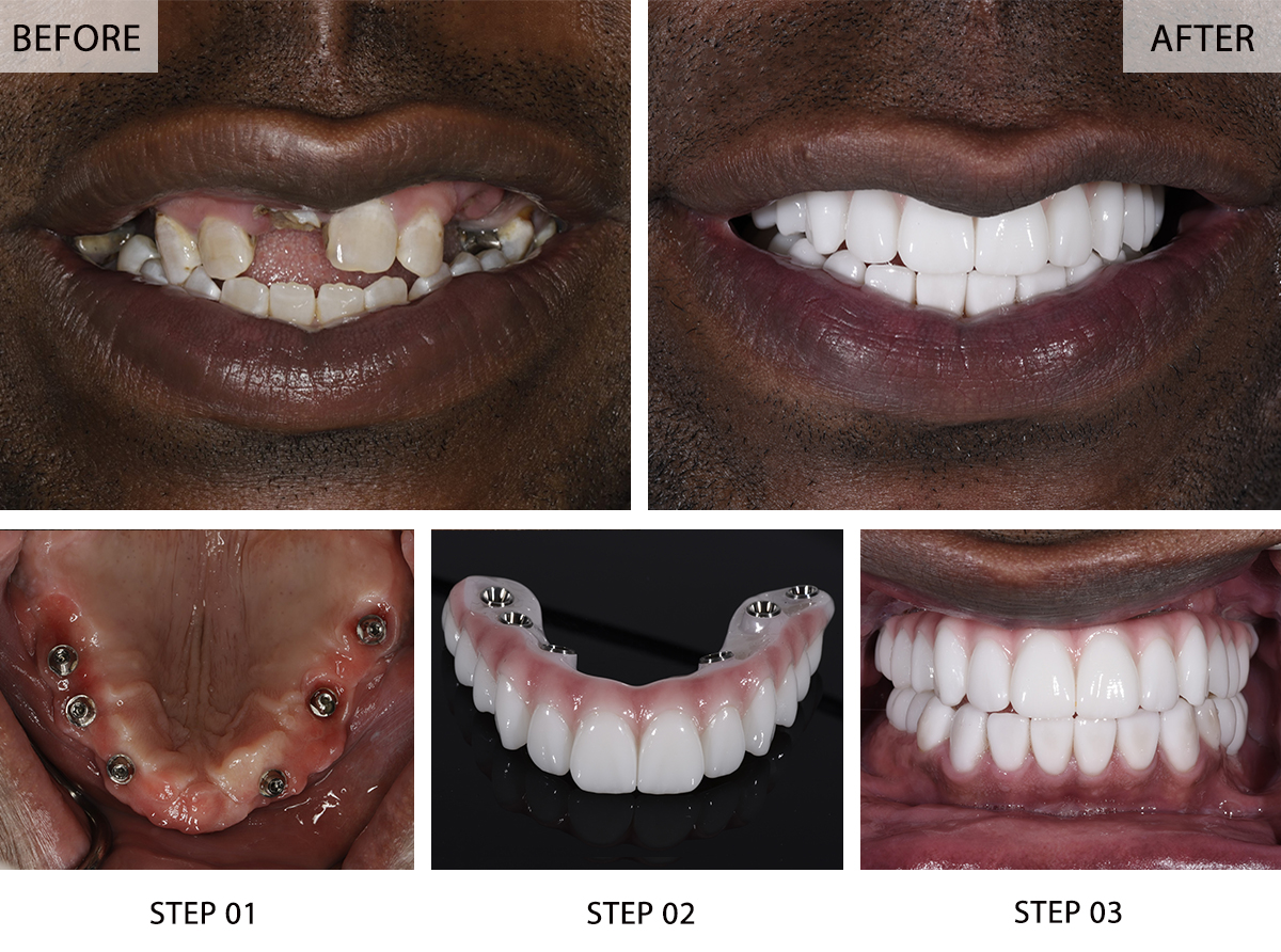 Crack Mouth Before And After Crack Mouth Before And After